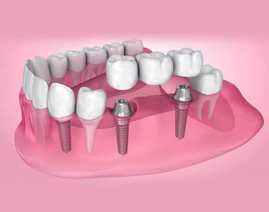 IMPLANT-SUPPORTED-DENTURE