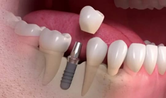 Dental Implants Thorton