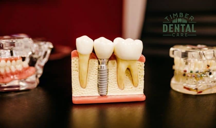 Dental Implants