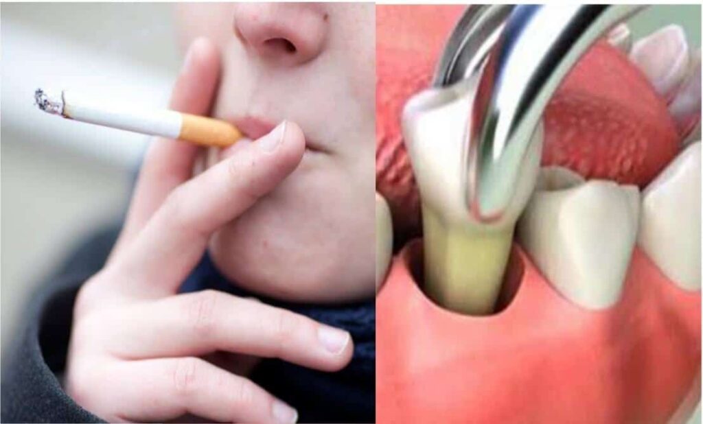 Can You Smoke After Dental Surgery?