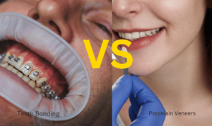 Dental Bonding vs Porcelain Veneers