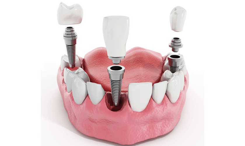 mini dental implants regular